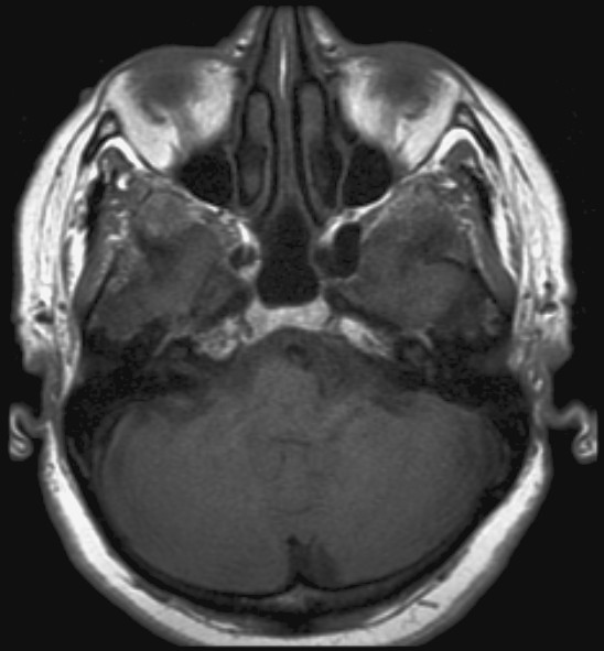 File:Acoustic schwannoma - intracanalicular (Radiopaedia 2624-6328 Axial T1 1).jpg