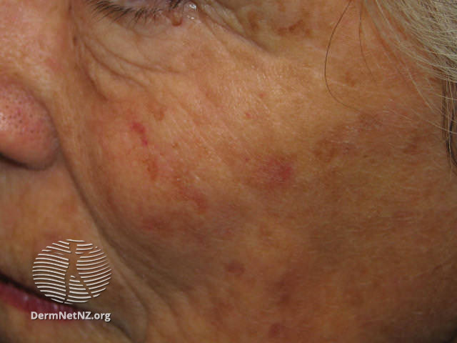 Actinic Keratoses affecting the face (DermNet NZ lesions-ak-face-243).jpg