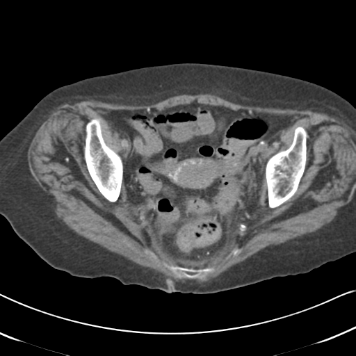 Active bleeding from duodenal ulcer with embolization (Radiopaedia 34216-35481 Axial non-contrast 58).png