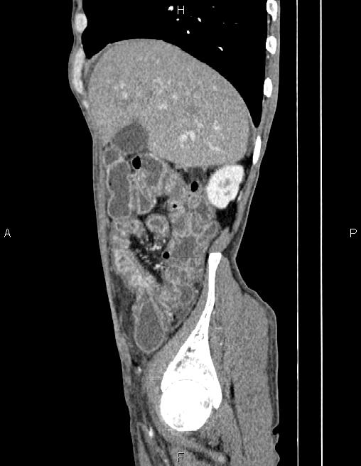 Active crohn disease (Radiopaedia 87133-103397 Sagittal C+ arterial phase 17).jpg