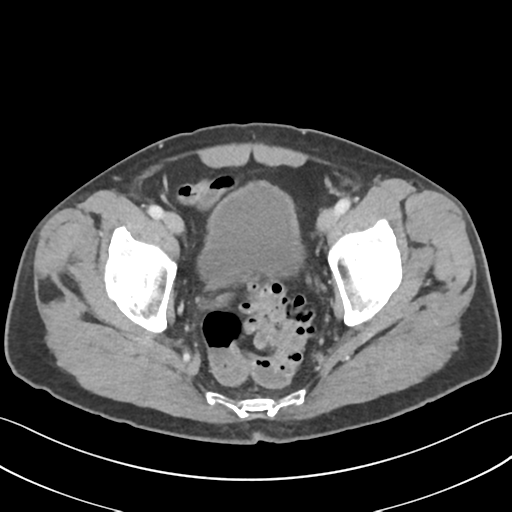 File:Active diverticular hemorrhage (Radiopaedia 39415-41725 Axial C+ portal venous phase 62).png
