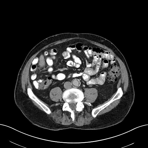 File:Active lower gastrointestinal bleeding - diverticular (Radiopaedia 61203-69106 Axial C+ portal venous phase 77).jpg