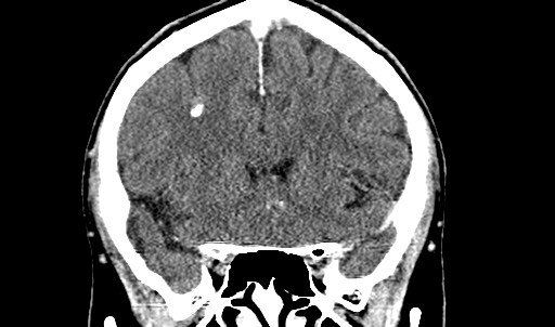File:Active neurocysticercosis before and after therapy (Radiopaedia 71710-82099 Coronal C+ delayed 29).jpg