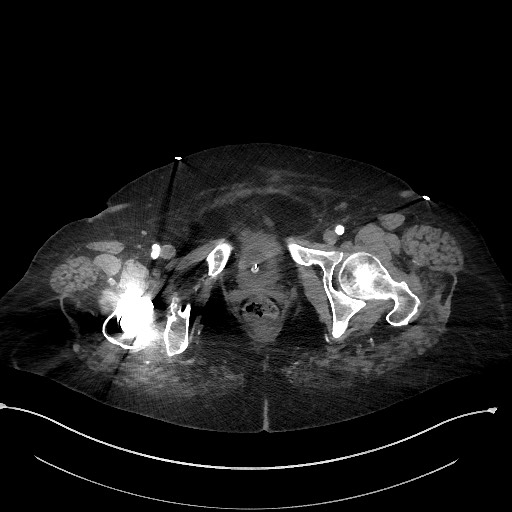 Active renal extravasation with large subcapsular and retroperitoneal hemorrhage (Radiopaedia 60975-68796 Axial C+ arterial phase 193).jpg