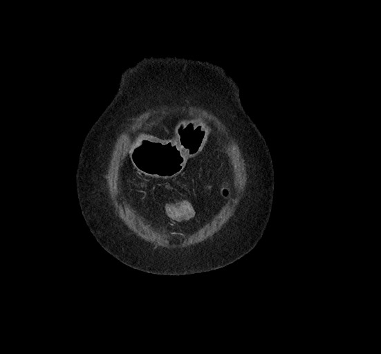 File:Active renal extravasation with large subcapsular and retroperitoneal hemorrhage (Radiopaedia 60975-68796 Coronal C+ portal venous phase 20).jpg