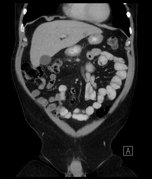 Acute-on-chronic pancreatitis (Radiopaedia 67286-76656 Coronal C+ portal venous phase 27).jpg