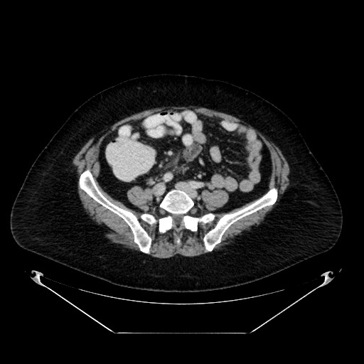 Acute appendicitis, heterotaxy syndrome (Radiopaedia 66884-76202 Axial C+ portal venous phase 87).jpg