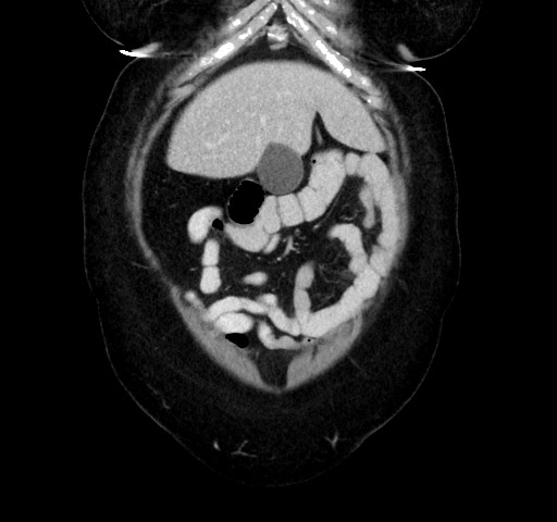 Acute appendicitis, heterotaxy syndrome (Radiopaedia 66884-76202 Coronal C+ portal venous phase 21).jpg