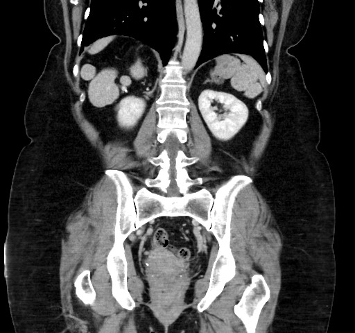 Acute appendicitis, heterotaxy syndrome (Radiopaedia 66884-76202 Coronal C+ portal venous phase 85).jpg