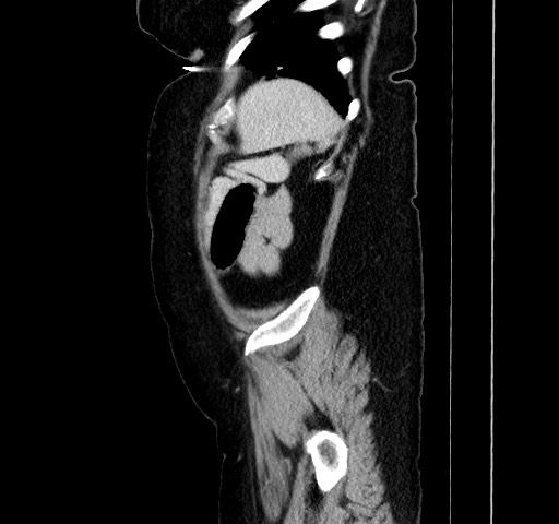 Acute appendicitis, heterotaxy syndrome (Radiopaedia 66884-76202 Sagittal C+ portal venous phase 112).jpg