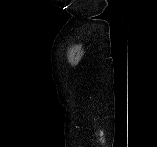 File:Acute appendicitis, heterotaxy syndrome (Radiopaedia 66884-76202 Sagittal C+ portal venous phase 14).jpg
