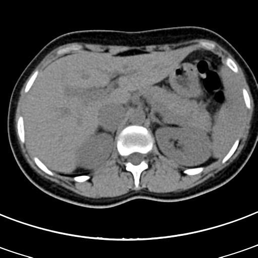 Acute appendicitis (Radiopaedia 30261-30888 Axial non-contrast 10).jpg