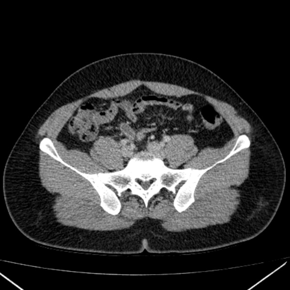Acute appendicitis (Radiopaedia 38255-40270 Axial C+ portal venous phase 78).jpg