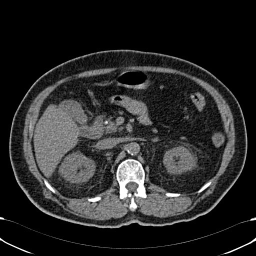 Acute appendicitis (Radiopaedia 58627-65818 Axial non-contrast 31).jpg