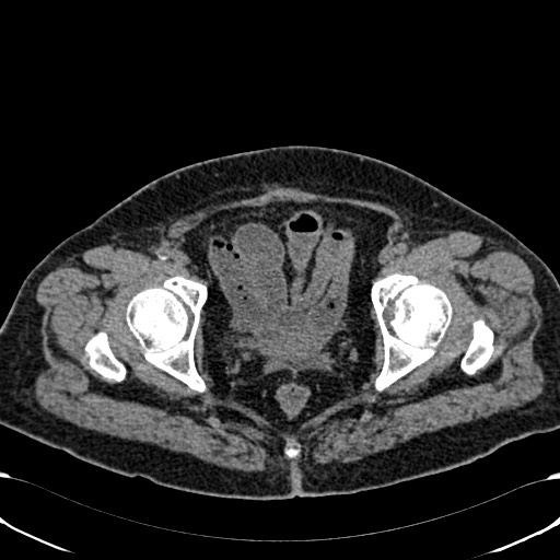 Acute appendicitis (Radiopaedia 58627-65818 Axial non-contrast 82).jpg