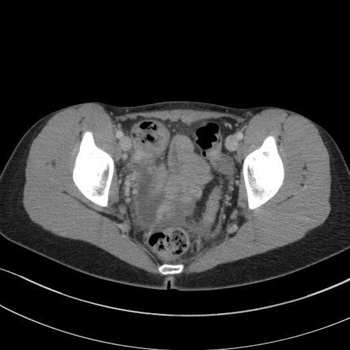 File:Acute appendicitis (Radiopaedia 62608-70901 Axial C+ portal venous phase 45).jpg