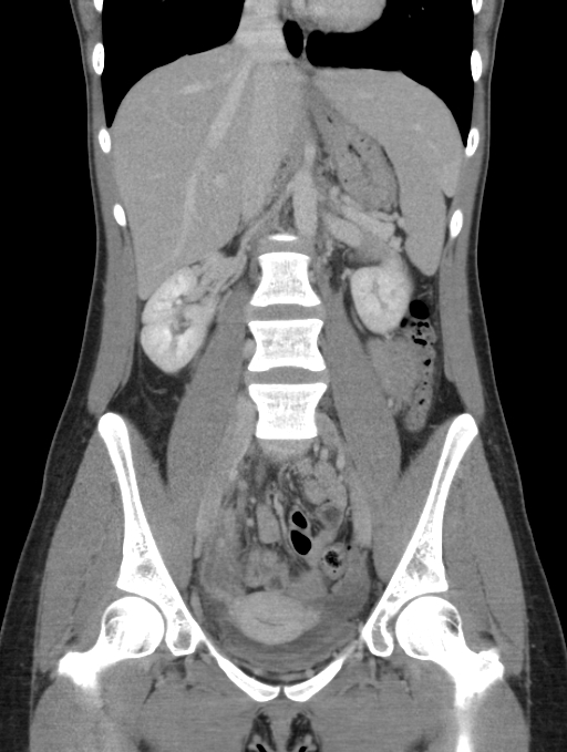 Acute appendicitis (Radiopaedia 62608-70901 Coronal C+ portal venous phase 25).jpg