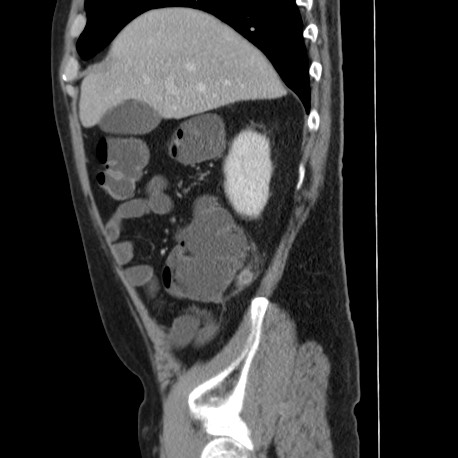 File:Acute appendicitis (Radiopaedia 66513-75790 Sagittal C+ portal venous phase 35).jpg