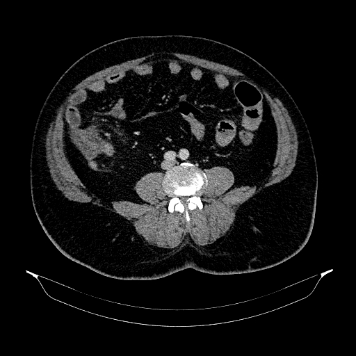 Acute appendicitis (Radiopaedia 79950-93224 Axial C+ portal venous phase 63).jpg