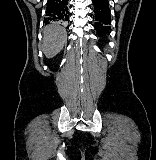 Acute appendicitis (Radiopaedia 79950-93224 Coronal C+ portal venous phase 81).jpg
