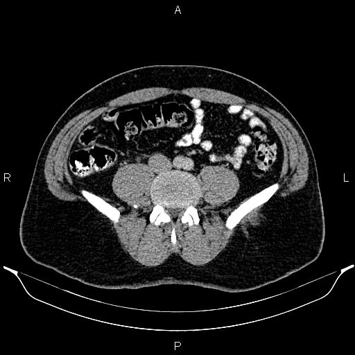 Acute appendicitis (Radiopaedia 84780-100240 Axial C+ portal venous phase 69).jpg