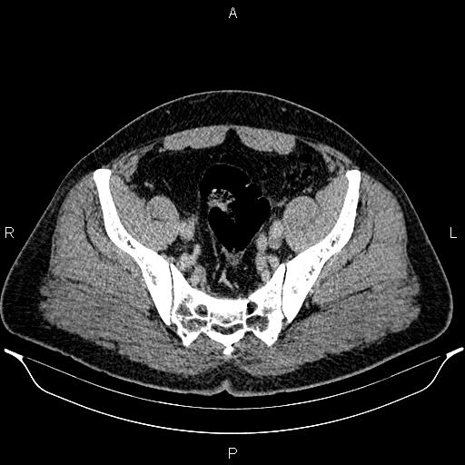 Acute appendicitis (Radiopaedia 84780-100240 Axial C+ portal venous phase 89).jpg
