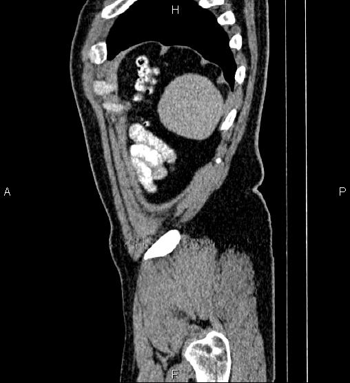 Acute appendicitis (Radiopaedia 84780-100240 Sagittal C+ portal venous phase 99).jpg