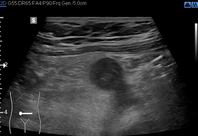 File:Acute appendicitis (Radiopaedia 85193-100745 D 151).jpg