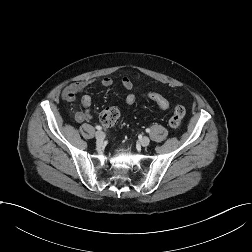 Acute appendicitis - large appendicoliths (Radiopaedia 61805-69820 Axial C+ portal venous phase 98).jpg