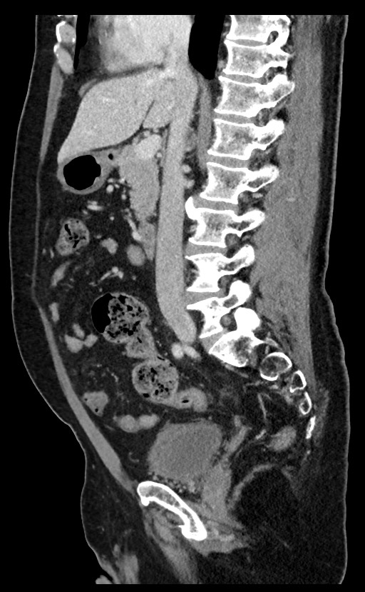 Acute appendicitis - large appendicoliths (Radiopaedia 61805-69820 Sagittal C+ portal venous phase 64).jpg