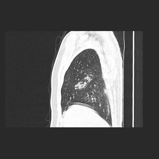 Acute appendicitis and COVID 19 pneumonia (Radiopaedia 76604-88380 Sagittal lung window 21).jpg