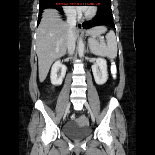 Acute appendicitis complicated by ovarian vein thrombophlebitis (Radiopaedia 16172-15851 Coronal C+ portal venous phase 47).jpg