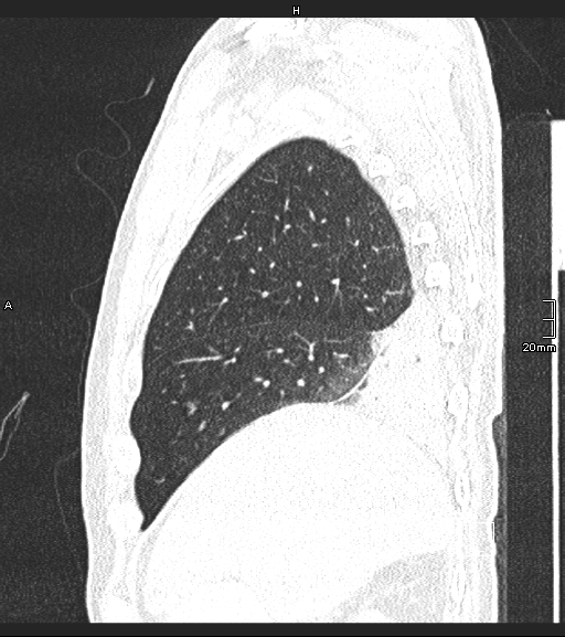 Acute aspiration pneumonitis (Radiopaedia 55642-62166 Sagittal lung window 125).jpg
