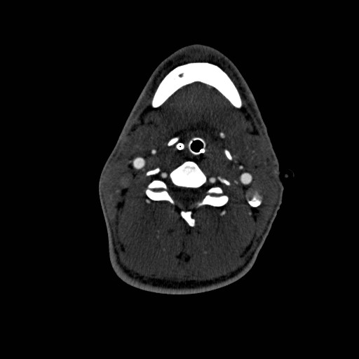 Acute basilar artery occlusion (Radiopaedia 43582-46985 Axial C+ arterial phase 190).jpg