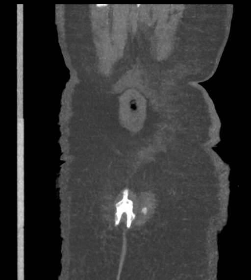 Acute bleed from gastric fundus biopsy site (Radiopaedia 35201-36737 Coronal C+ arterial phase 54).png
