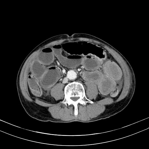Acute bowel ischemia (Radiopaedia 87695-104114 Axial C+ portal venous phase 50).jpg