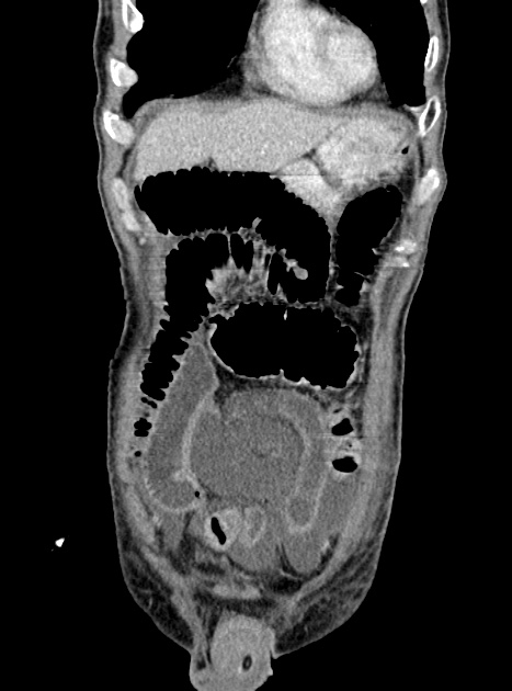 Acute bowel ischemia (Radiopaedia 87695-104114 Coronal C+ portal venous phase 109).jpg