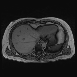 File:Acute cholecystitis (Radiopaedia 72392-82923 Axial T1 out-of-phase 26).jpg