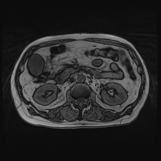 Acute cholecystitis (Radiopaedia 72392-82923 Axial T1 out-of-phase 66).jpg