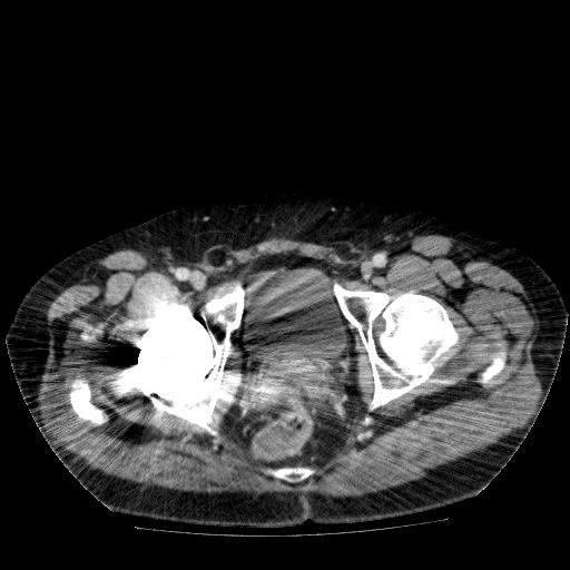 File:Acute cholecystitis and incidental left sided IVC (Radiopaedia 49352-54459 Axial C+ portal venous phase 149).jpg
