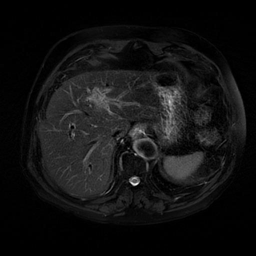 File:Acute cholecystitis complicated by pylephlebitis (Radiopaedia 65782-74915 Axial T2 fat sat 11).jpg