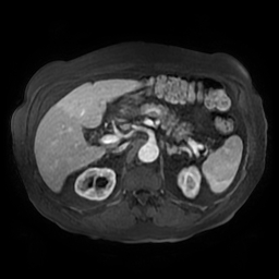Acute cholecystitis complicated by pylephlebitis (Radiopaedia 65782-74915 Axial arterioportal phase T1 C+ fat sat 57).jpg