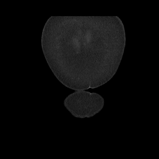 Acute cholecystitis with tensile fundus sign (Radiopaedia 71394-81723 Coronal non-contrast 14).jpg