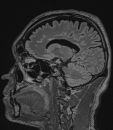 Acute disseminated encephalomyelitis (ADEM)- Anti-NMDA receptor encephalitis (Radiopaedia 54920-61201 Sagittal FLAIR 37).png