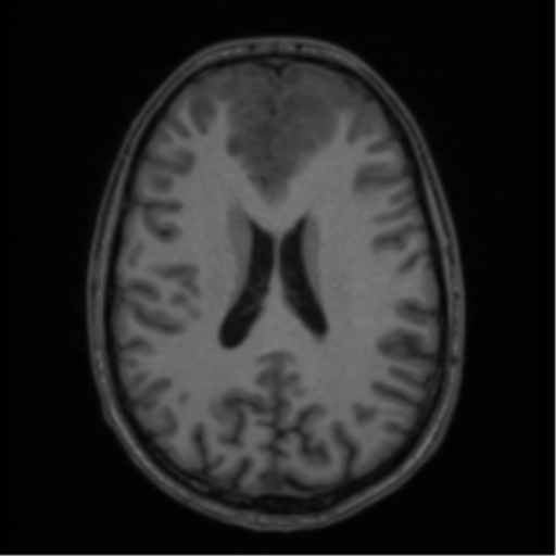 Acute disseminated encephalomyelitis (ADEM) (Radiopaedia 65319-74349 Axial T1 41).png