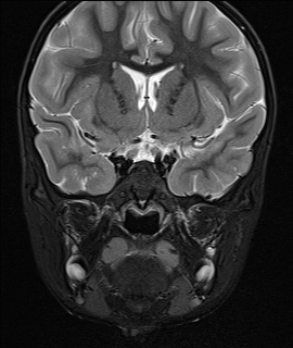 File:Acute disseminating encephalomyelitis with bilateral optic neuritis (Radiopaedia 79676-92886 Coronal STIR 15).jpg