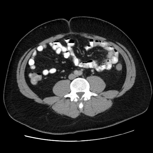 Acute diverticulitis with localized perforation (Radiopaedia 41296-44113 Axial C+ portal venous phase 52).jpg