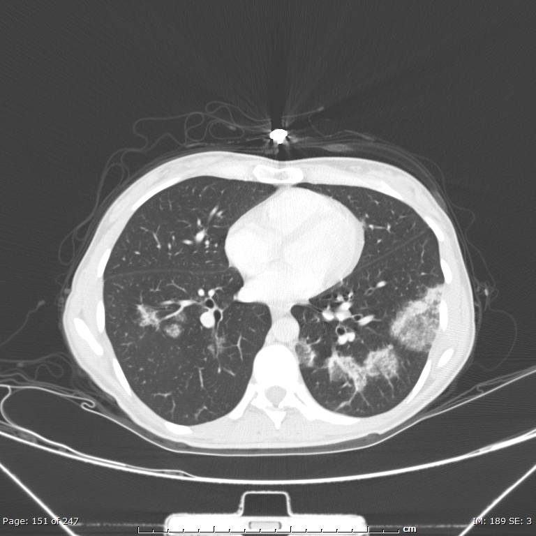 Acute eosinophilic pneumonia (Radiopaedia 48211-53073 Axial lung window 54).jpg