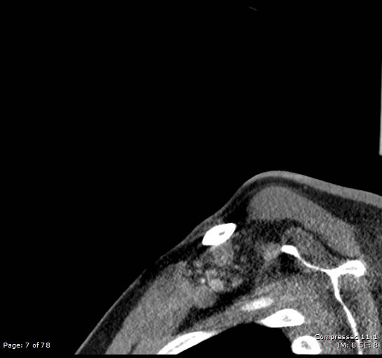 Acute epiglottitis (Radiopaedia 54375-60590 Sagittal C+ arterial phase 7).jpg