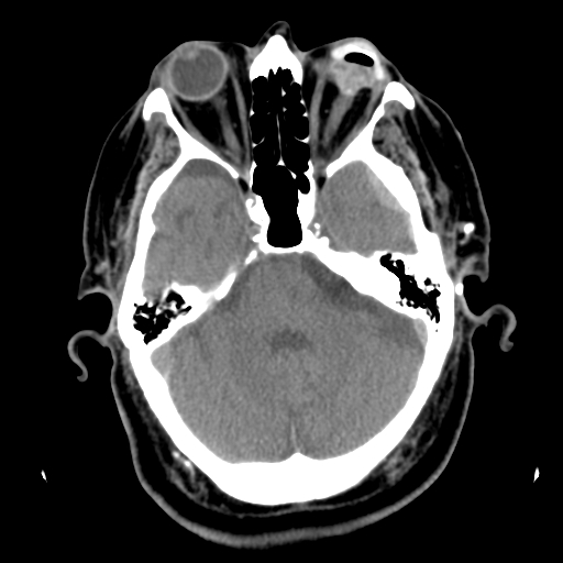 Acute hemorrhagic stroke (Radiopaedia 17507-17223 Axial non-contrast 15).jpg